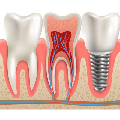 Dental implant and real tooth anatomy closeup cut away section model side view realistic vector illustration